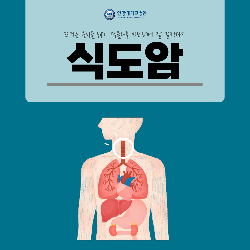 뜨거운 음식을 잘 먹는 사람일수록 식도암에 걸릴 확률이 높다?